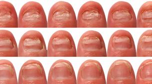 nail_regrowth_lg Kalknagel voorbeelden