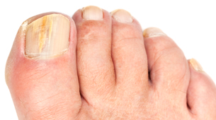 MYC_visual-superficial-white-onychomycosis-1_high-res Kalknagel symptomen Mycosan