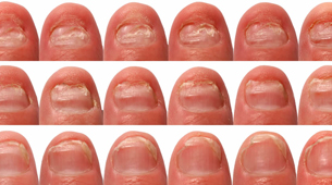 nail_regrowth_lg Kalknagel voorbeelden