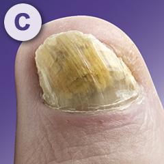 Mycosan nagel